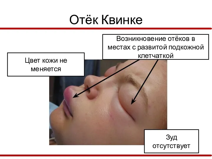 Отёк Квинке Возникновение отёков в местах с развитой подкожной клетчаткой Цвет кожи не меняется Зуд отсутствует