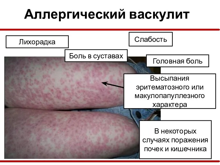 Аллергический васкулит Лихорадка Боль в суставах Слабость Головная боль В