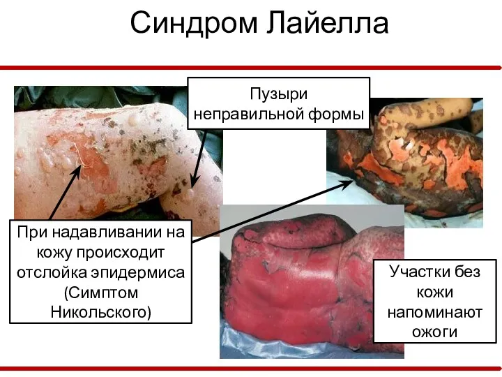 Синдром Лайелла Участки без кожи напоминают ожоги Пузыри неправильной формы