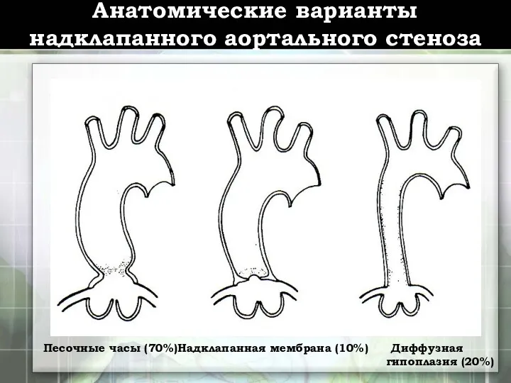 Анатомические варианты надклапанного аортального стеноза Песочные часы (70%)Надклапанная мембрана (10%) Диффузная гипоплазия (20%)