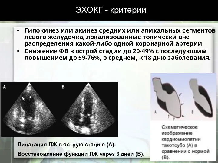 ЭХОКГ - критерии Гипокинез или акинез средних или апикальных сегментов