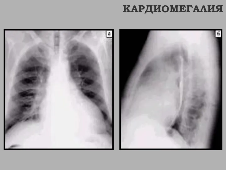 КАРДИОМЕГАЛИЯ