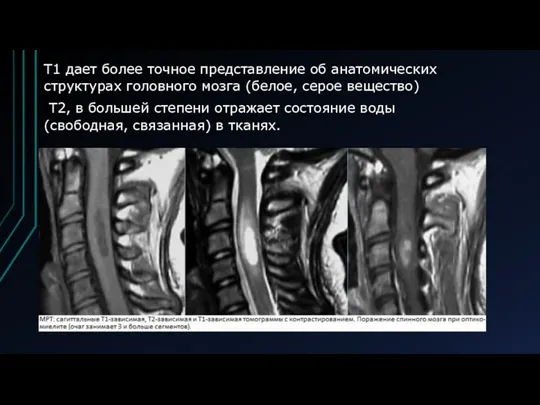 Т1 дает более точное представление об анатомических структурах головного мозга