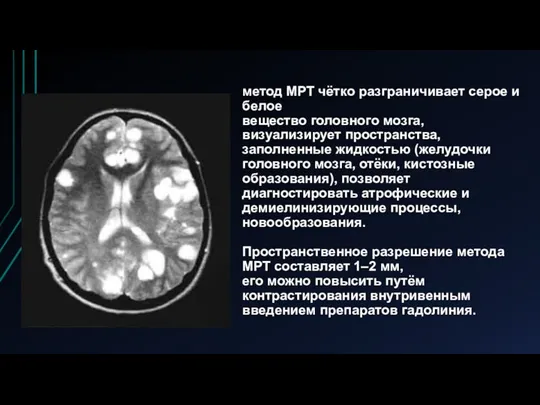 метод МРТ чётко разграничивает серое и белое вещество головного мозга,