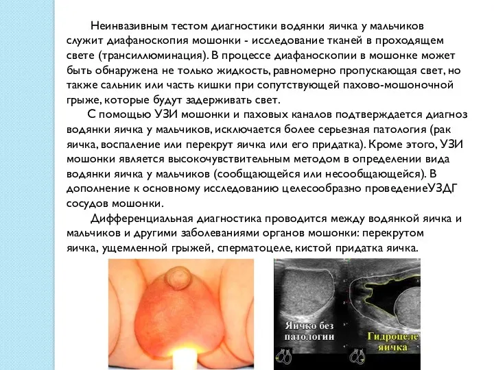 Неинвазивным тестом диагностики водянки яичка у мальчиков служит диафаноскопия мошонки