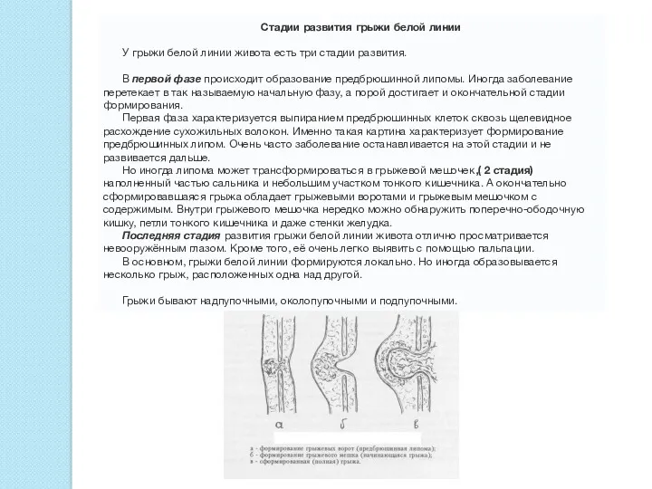 Стадии развития грыжи белой линии У грыжи белой линии живота