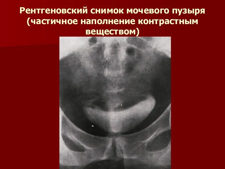Рентгеновский снимок мочевого пузыря (частичное наполнение контрастным веществом)