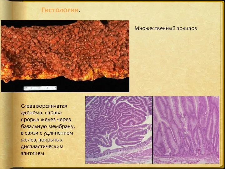 Гистология. Слева ворсинчатая аденома, справа прорыв желез через базальную мембрану, в связи с