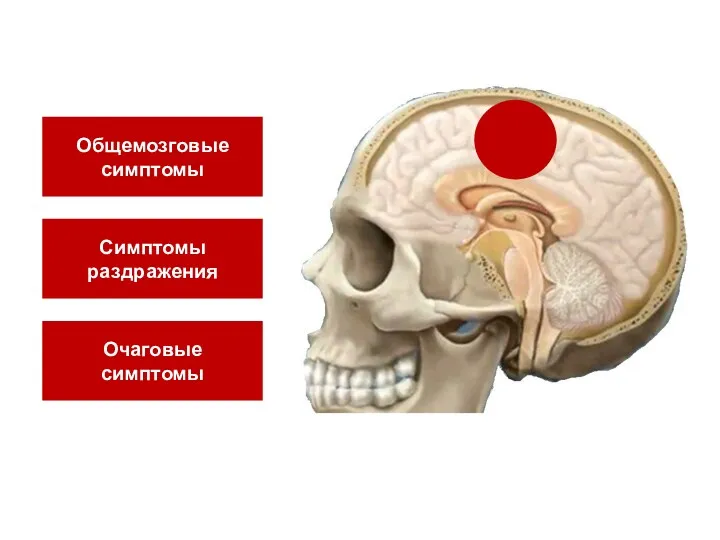 Общемозговые симптомы Симптомы раздражения Очаговые симптомы