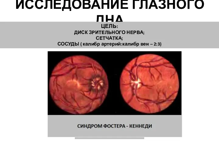 ИССЛЕДОВАНИЕ ГЛАЗНОГО ДНА ЦЕЛЬ: ДИСК ЗРИТЕЛЬНОГО НЕРВА; СЕТЧАТКА; СОСУДЫ ( калибр артерий:калибр вен – 2:3)