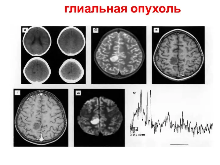 глиальная опухоль