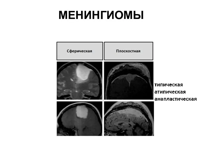 МЕНИНГИОМЫ