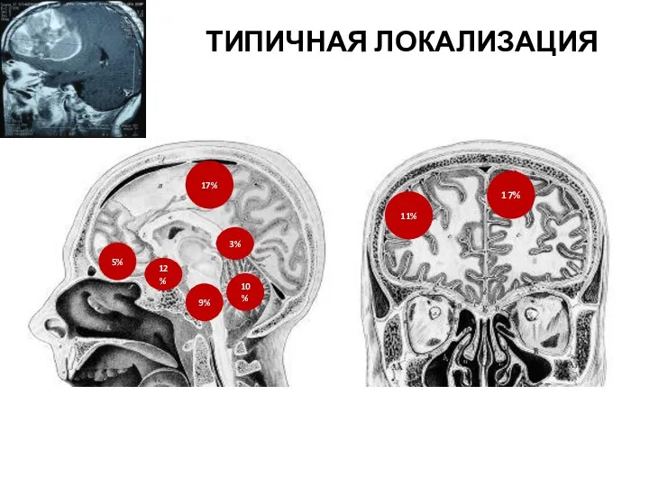 ТИПИЧНАЯ ЛОКАЛИЗАЦИЯ 17% 17% 11% 9% 5% 12% 10% 3%