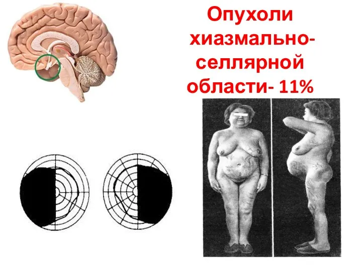 Опухоли хиазмально-селлярной области- 11%