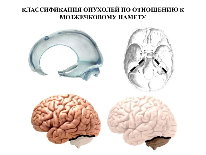 КЛАССИФИКАЦИЯ ОПУХОЛЕЙ ПО ОТНОШЕНИЮ К МОЗЖЕЧКОВОМУ НАМЕТУ