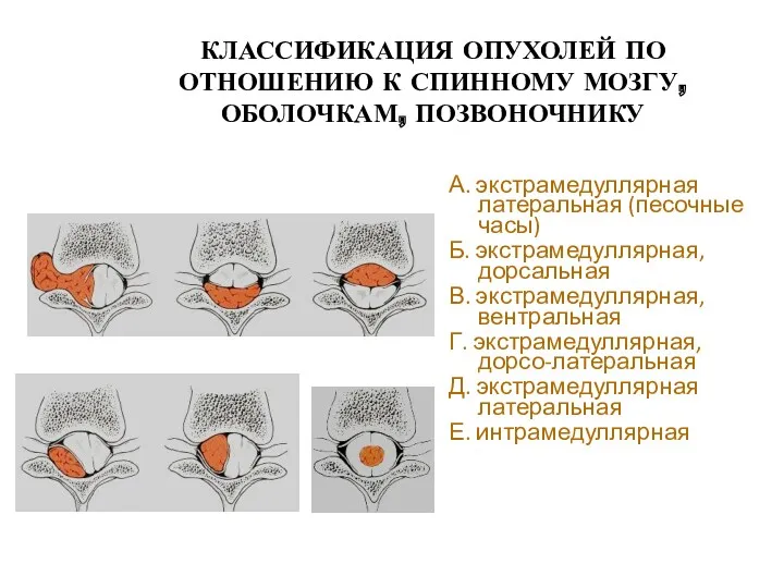 КЛАССИФИКАЦИЯ ОПУХОЛЕЙ ПО ОТНОШЕНИЮ К СПИННОМУ МОЗГУ, ОБОЛОЧКАМ, ПОЗВОНОЧНИКУ А.