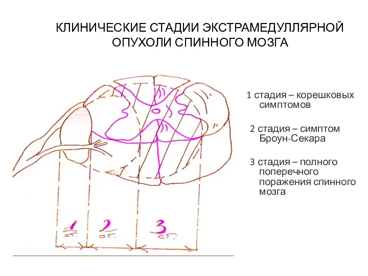 КЛИНИЧЕСКИЕ СТАДИИ ЭКСТРАМЕДУЛЛЯРНОЙ ОПУХОЛИ СПИННОГО МОЗГА 1 стадия – корешковых