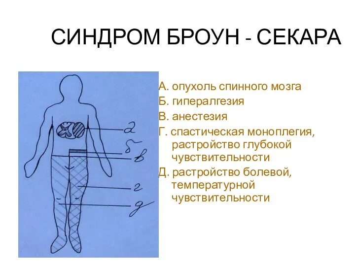 СИНДРОМ БРОУН - СЕКАРА А. опухоль спинного мозга Б. гипералгезия