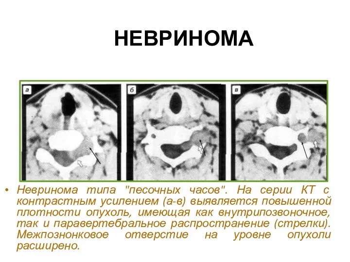 НЕВРИНОМА Невринома типа "песочных часов". На серии КТ с контрастным