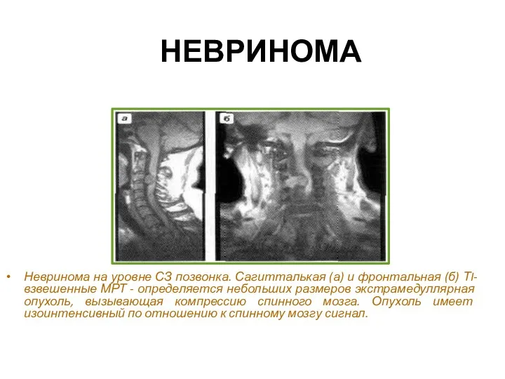 НЕВРИНОМА Невринома на уровне СЗ позвонка. Сагитталькая (а) и фронтальная