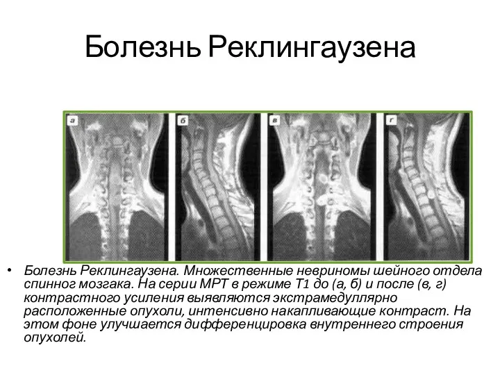 Болезнь Реклингаузена Болезнь Реклингаузена. Множественные невриномы шейного отдела спинног мозгака.