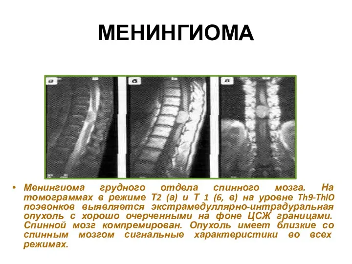 МЕНИНГИОМА Менингиома грудного отдела спинного мозга. На томограммах в режиме