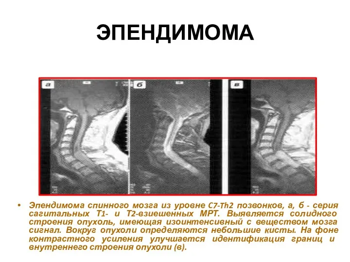 ЭПЕНДИМОМА Эпендимома спинного мозга из уровне C7-Th2 позвонков, а, б