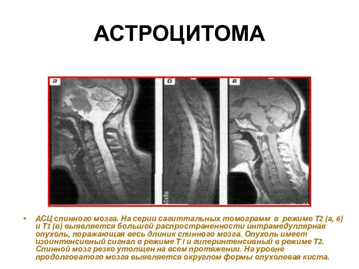 АСТРОЦИТОМА АСЦ спинного мозга. На серии сагиттальных томограмм в режиме