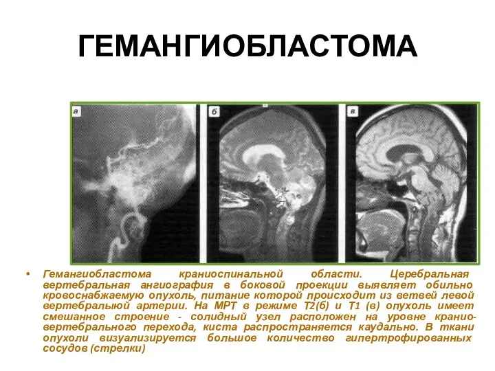 ГЕМАНГИОБЛАСТОМА Гемангиобластома краниоспинальной области. Церебральная вертебральная ангиография в боковой проекции