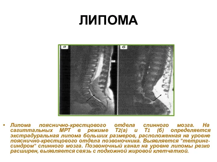 ЛИПОМА Липома пояснично-крестцового отдела спинного мозга. На сагиттальных МРТ в