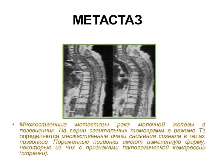 МЕТАСТАЗ Множественные метастазы рака молочной железы в позвоночник. На серии