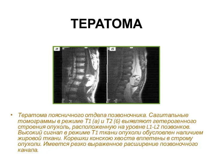 ТЕРАТОМА Тератома поясничного отдела позвоночника. Сагитальные томограммы в режиме Т1