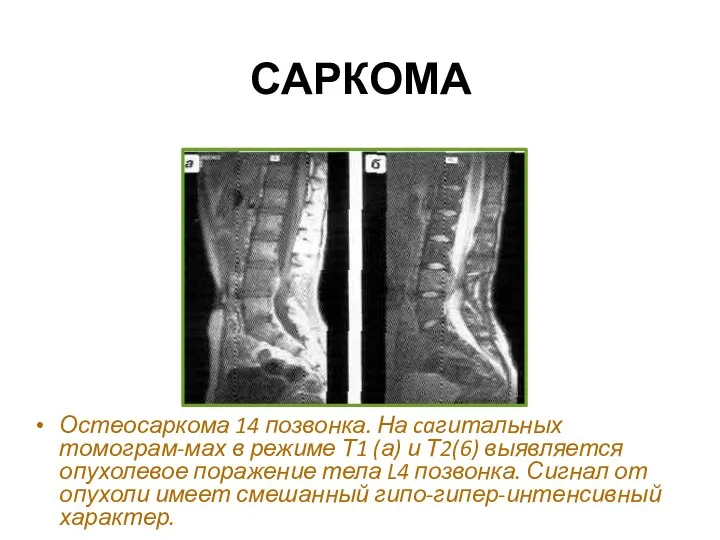 САРКОМА Остеосаркома 14 позвонка. На caгитальных томограм-мах в режиме Т1