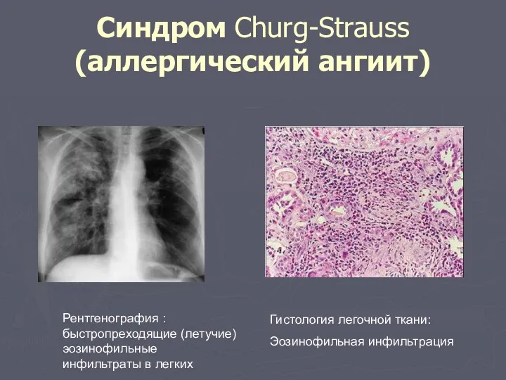 Синдром Churg-Strauss (аллергический ангиит) Рентгенография : быстропреходящие (летучие) эозинофильные инфильтраты