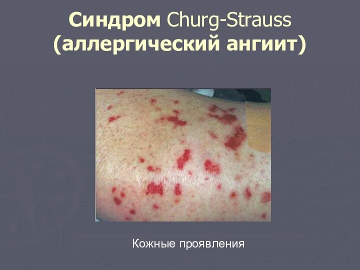 Синдром Churg-Strauss (аллергический ангиит) Кожные проявления