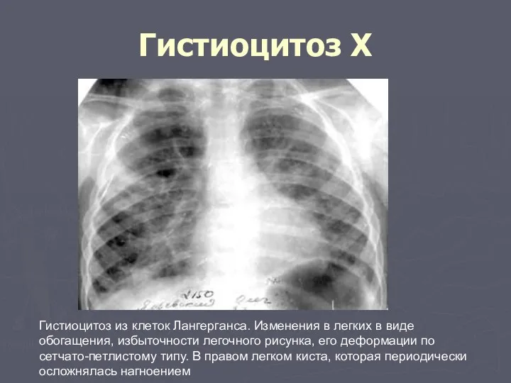 Гистиоцитоз Х Гистиоцитоз из клеток Лангерганса. Изменения в легких в