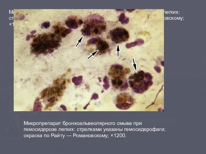 Микропрепарат бронхоальвеолярного смыва при гемосидерозе легких: стрелками указаны гемосидерофаги; окраска