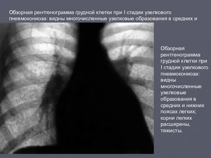 Обзорная рентгенограмма грудной клетки при I стадии узелкового пневмокониоза: видны