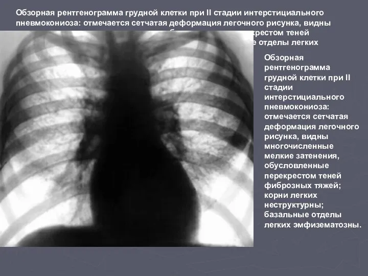 Обзорная рентгенограмма грудной клетки при II стадии интерстициального пневмокониоза: отмечается