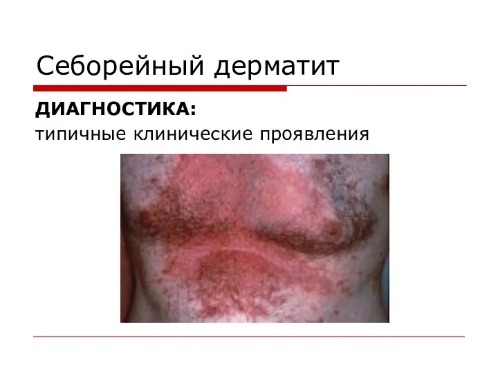 Себорейный дерматит ДИАГНОСТИКА: типичные клинические проявления