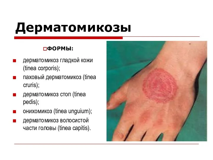 Дерматомикозы дерматомикоз гладкой кожи (tinea corporis); паховый дерматомикоз (tinea cruris); дерматомикоз стоп (tinea