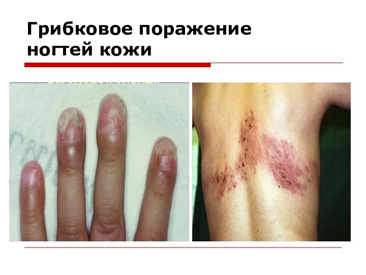 Грибковое поражение ногтей кожи
