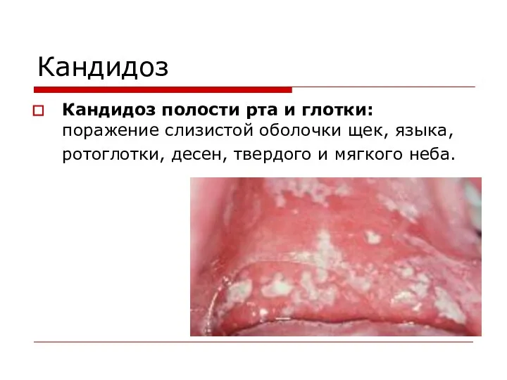 Кандидоз Кандидоз полости рта и глотки: поражение слизистой оболочки щек, языка, ротоглотки, десен,
