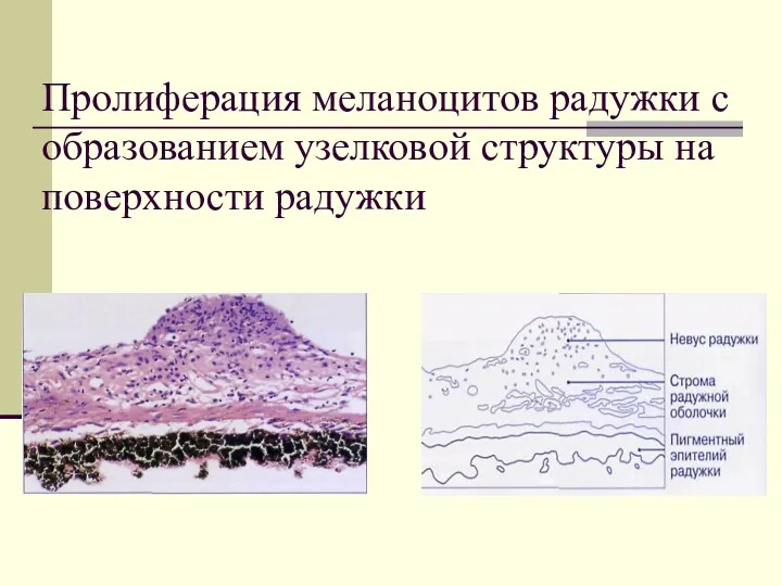 Пролиферация меланоцитов радужки с образованием узелковой структуры на поверхности радужки