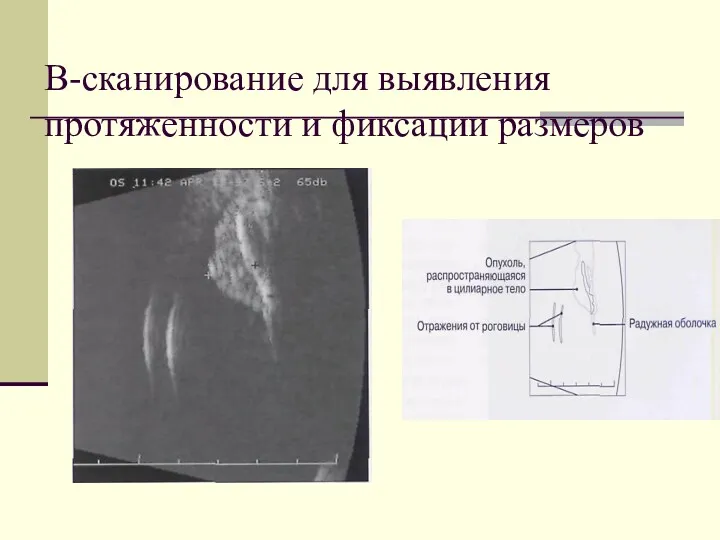 В-сканирование для выявления протяженности и фиксации размеров