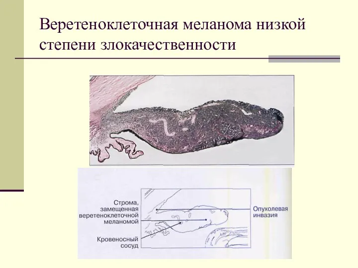 Веретеноклеточная меланома низкой степени злокачественности