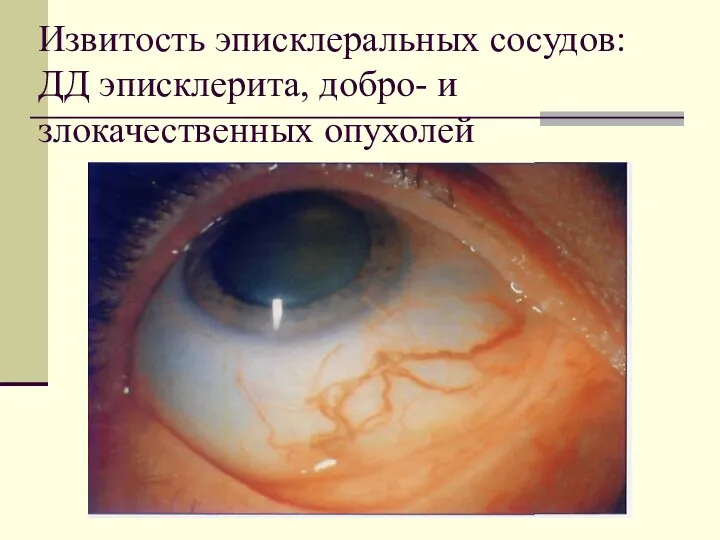 Извитость эписклеральных сосудов: ДД эписклерита, добро- и злокачественных опухолей