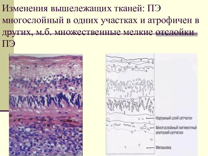 Изменения вышележащих тканей: ПЭ многослойный в одних участках и атрофичен