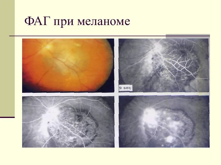 ФАГ при меланоме