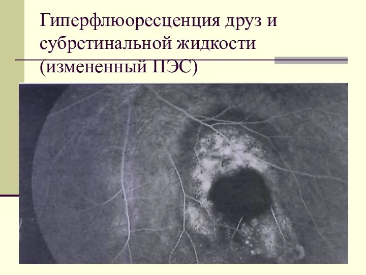 Гиперфлюоресценция друз и субретинальной жидкости (измененный ПЭС)